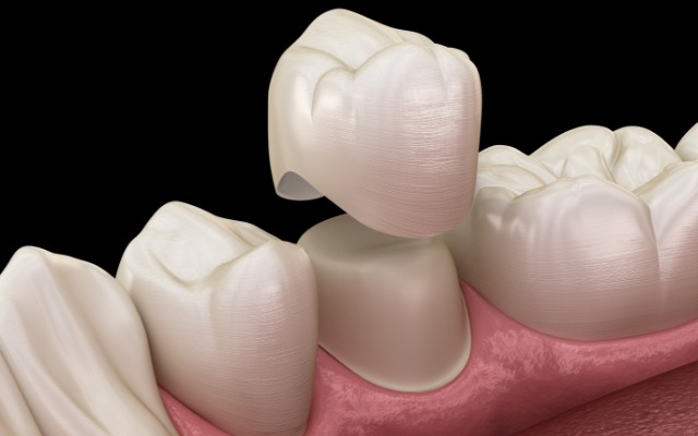 Animated smile during dental crown placement