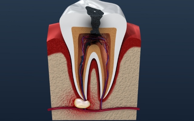 Animated tooth in need of root canal treatment