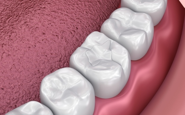 Animated smile with dental sealants