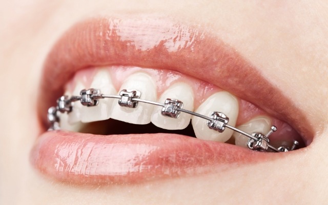 Closeup of smile with traditional orthodontics