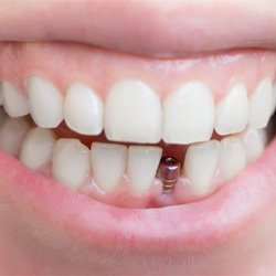 A dental implant in Chaska