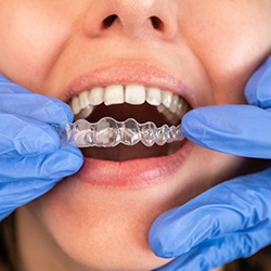 Dentist inserting clear aligner