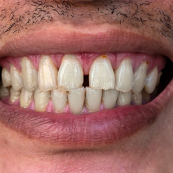 Up-close view of a gap between two front teeth