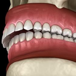 Image of an overbite
