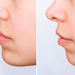 Image of a patient’s underbite before and after