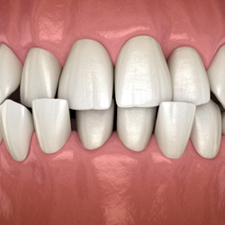 Image of a patient’s underbite before and after