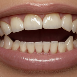 Front upper and lower teeth not touching