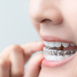 Female inserting her Invisalign aligners 