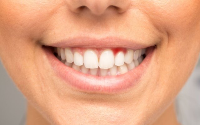 Closeup of inflamed gums before gum disease treatment