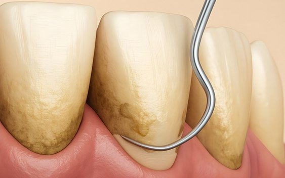 Scaling and root planing in Chaska digital image