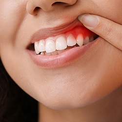 Woman showing red gum tissues