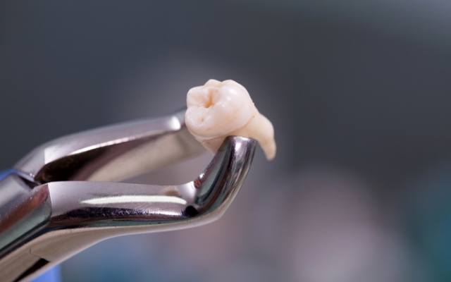woman tooth extraction