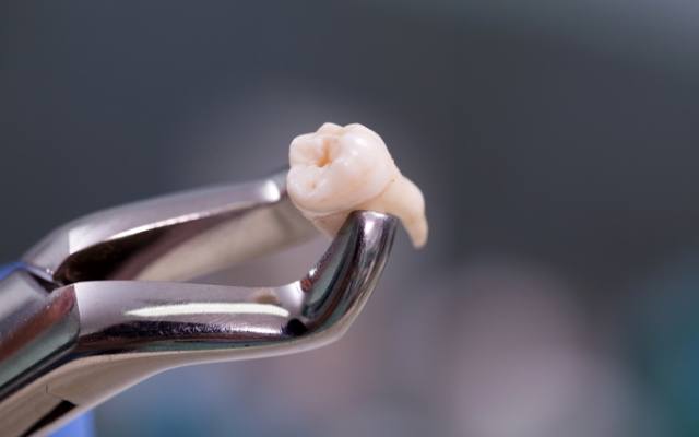 Metal clasp holding an extracted tooth