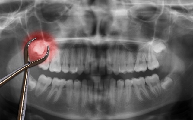 X ray showing an impacted tooth before extraction