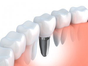 Dental implants from Chaska Dental Center change lives affordably. Replacing one or more teeth, implants recreate new smiles for a lifetime.