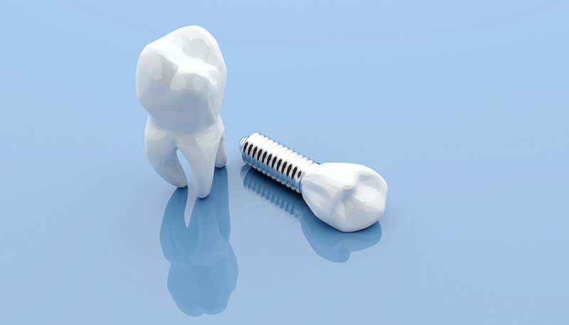 dental implant blue background