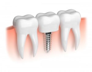 Illustration of dental implants.