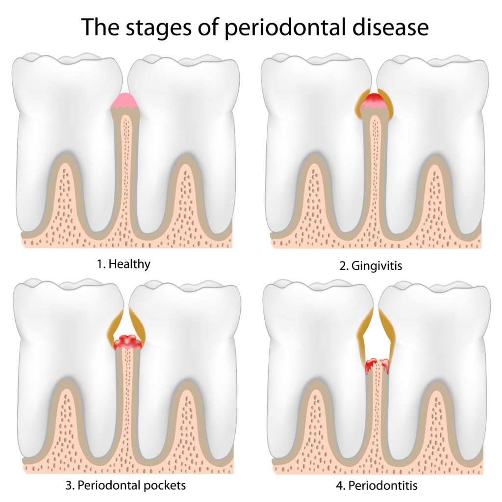 Illustration of the stages of gum disease
