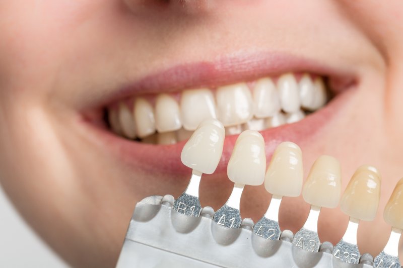 an up-close look at a shade guide used to determine the appropriate color for a person’s veneers