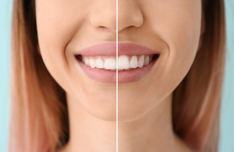 a side-by-side image of a woman’s smile and how her teeth look after a gum lift in Chaska