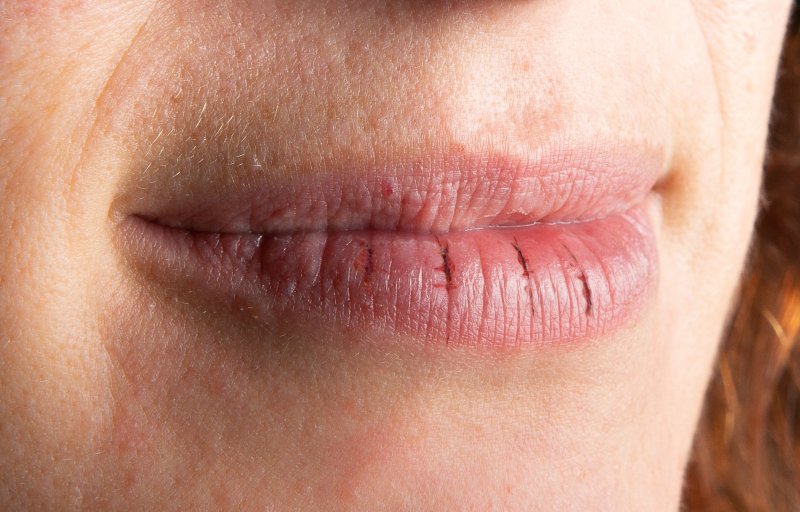 up-close image of a person’s dry and cracked lips