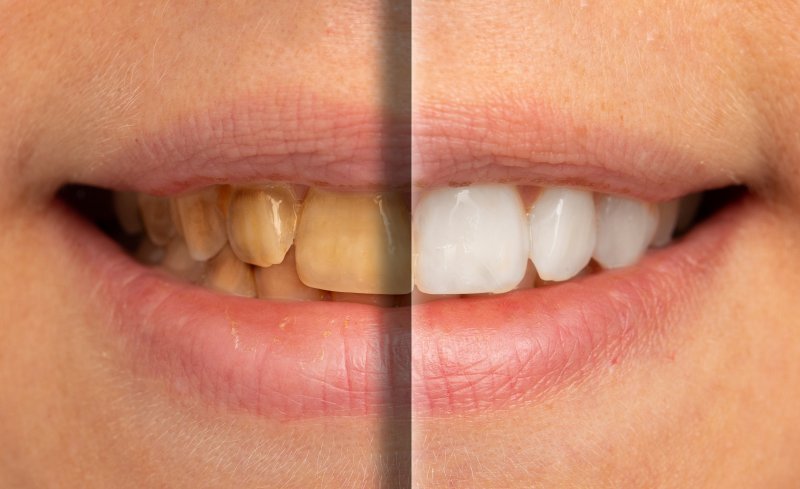 before and after teeth whitening