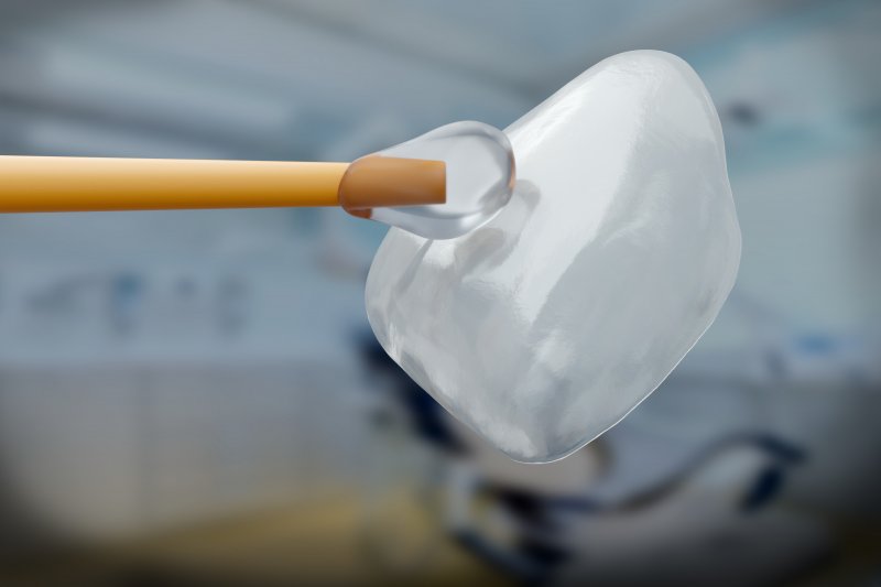 a single dental veneer