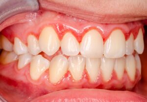 up-close view of a person&rsquo;s soft gum tissue